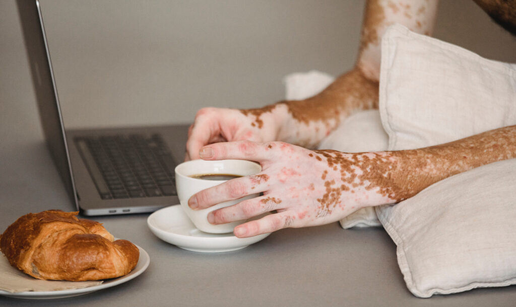 Association Belge du Vitiligo